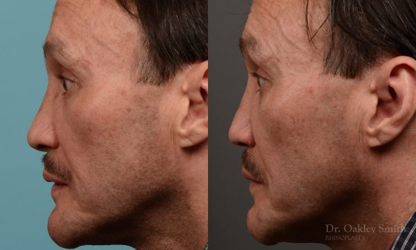 OHIP rhinoplasty for functional breathing