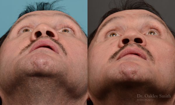 OHIP rhinoplasty for functional breathing