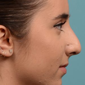 Female nose hump reduction rhinoplasty