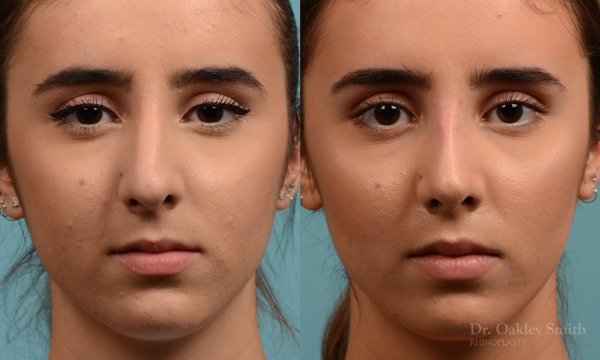 Female nose hump reduction rhinoplasty