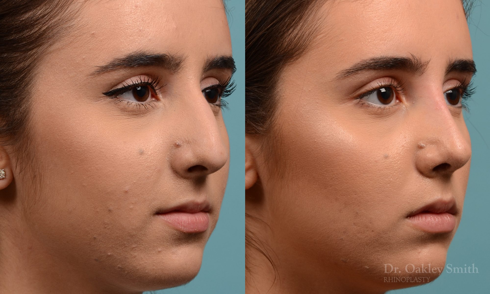 Female nose hump reduction rhinoplasty
