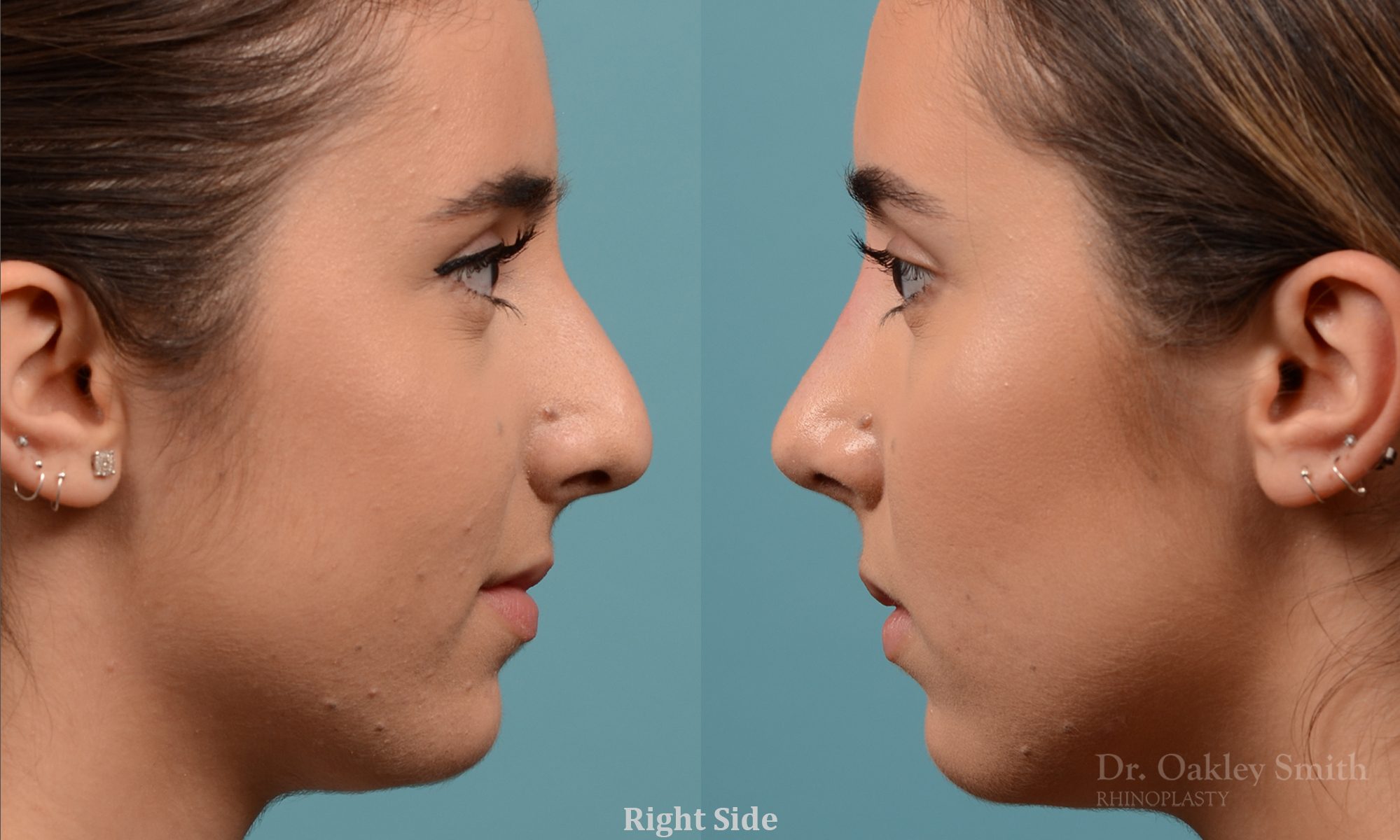 Female nose hump reduction rhinoplasty