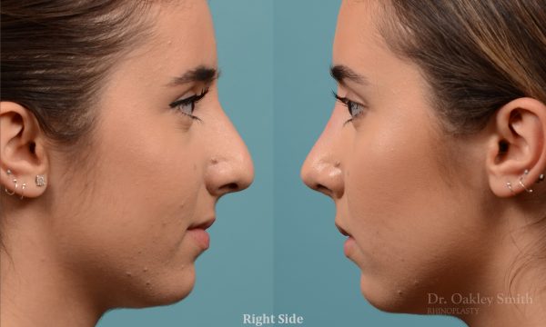 Female nose hump reduction rhinoplasty