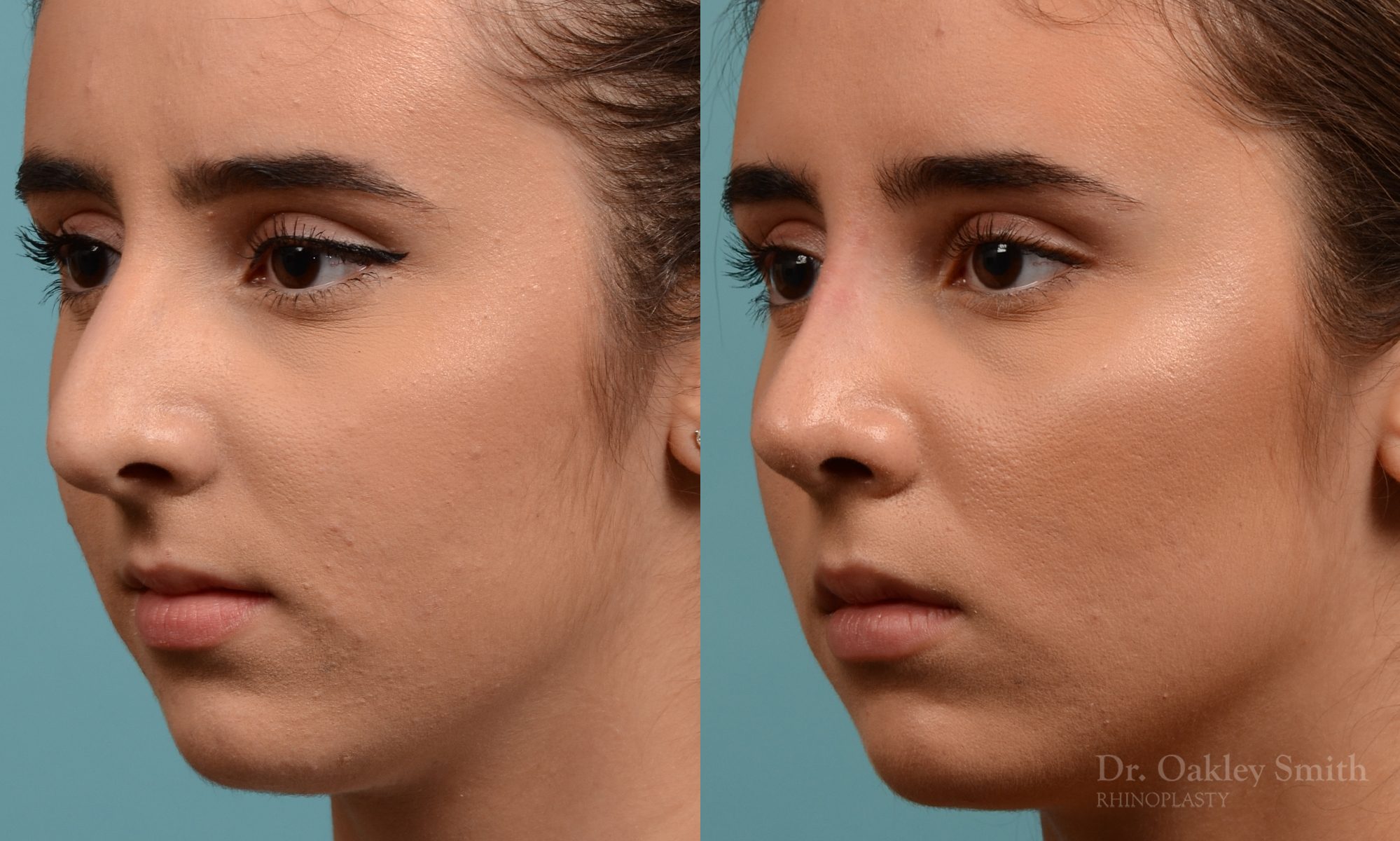 Female nose hump reduction rhinoplasty