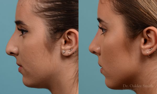 Female nose hump reduction rhinoplasty
