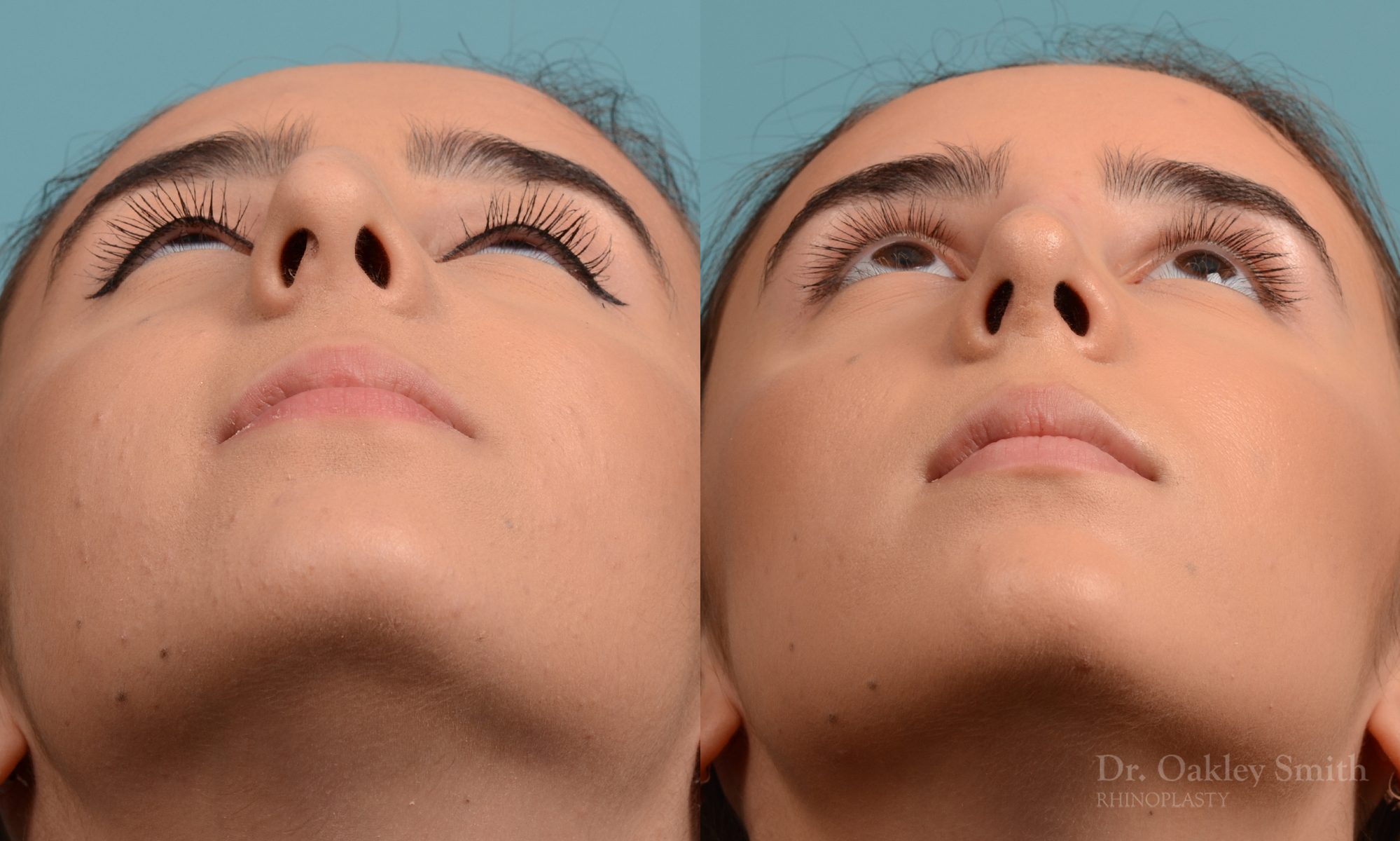Female nose hump reduction rhinoplasty