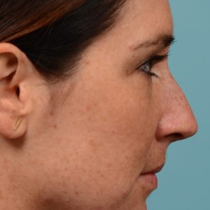 Straighten nose rhinoplasty