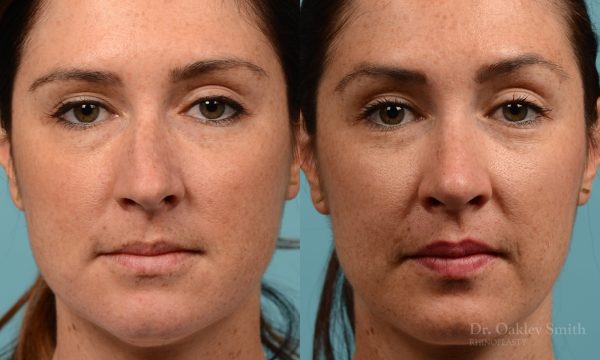 Straighten nose rhinoplasty