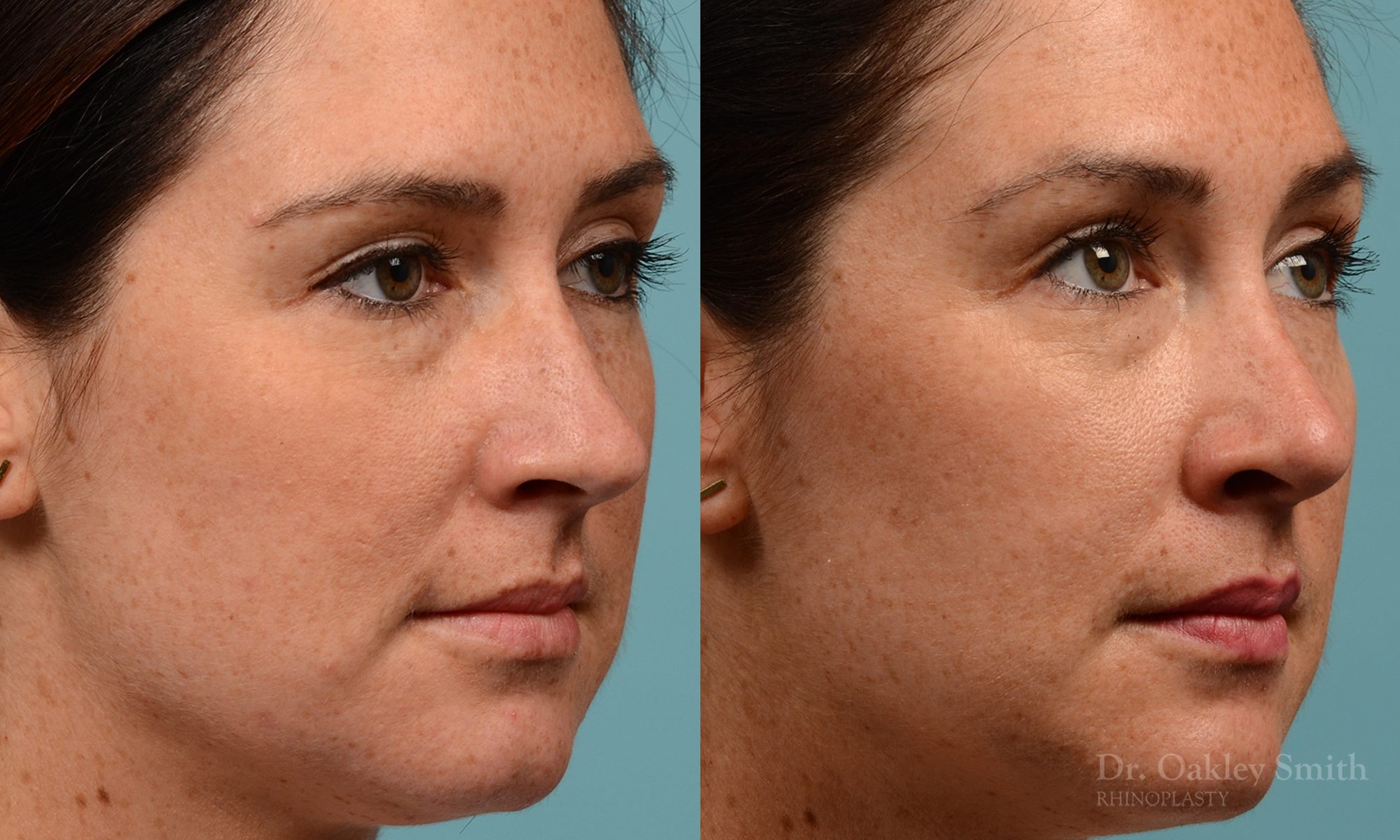 Straighten nose rhinoplasty