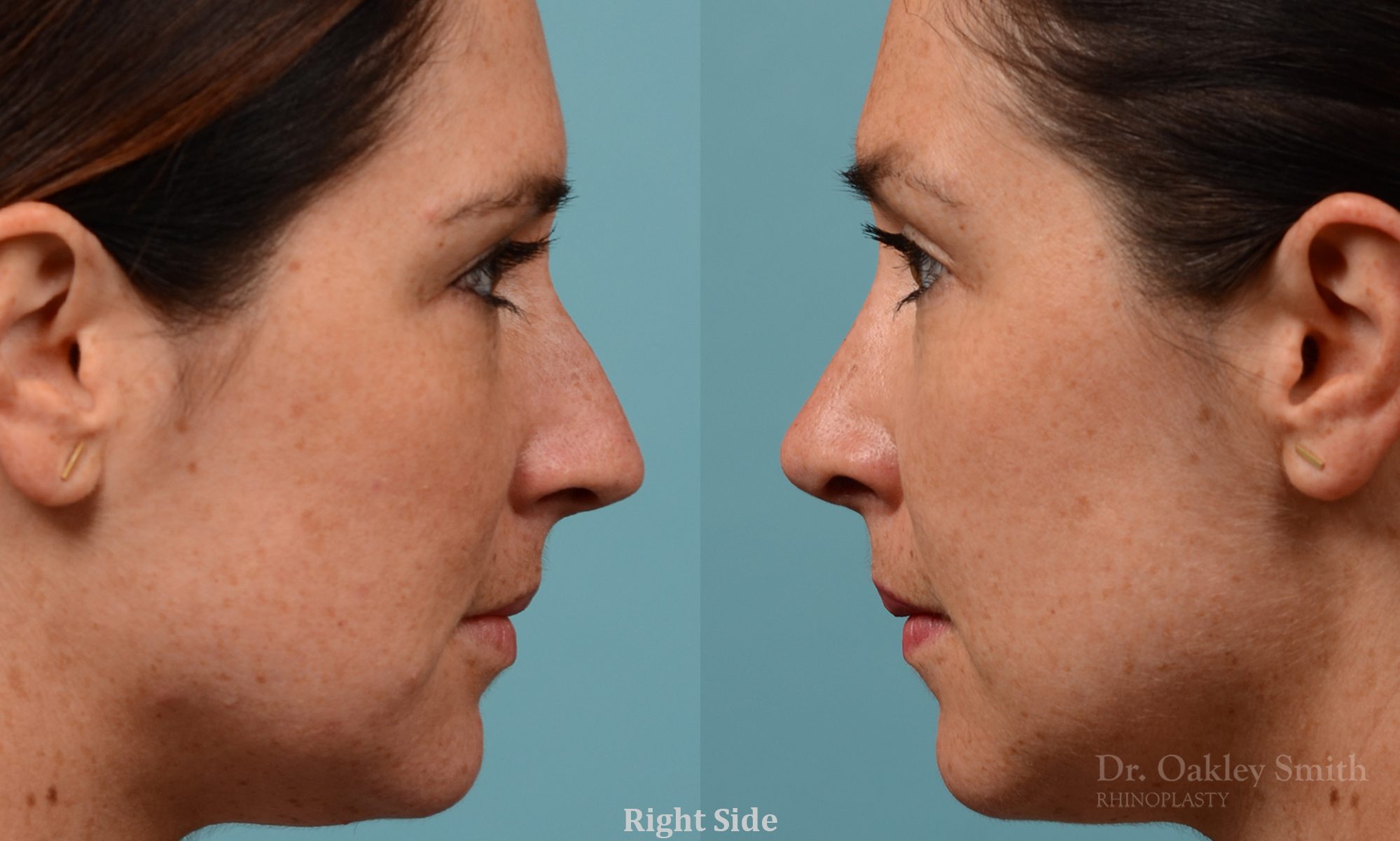 Straighten nose rhinoplasty