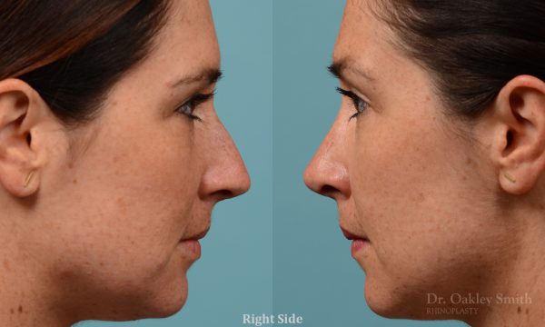 Straighten nose rhinoplasty
