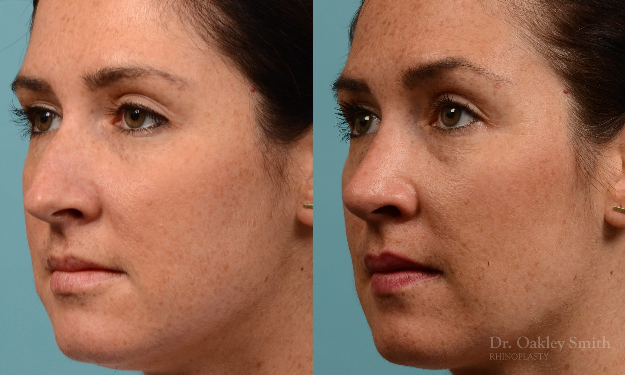 Straighten nose rhinoplasty