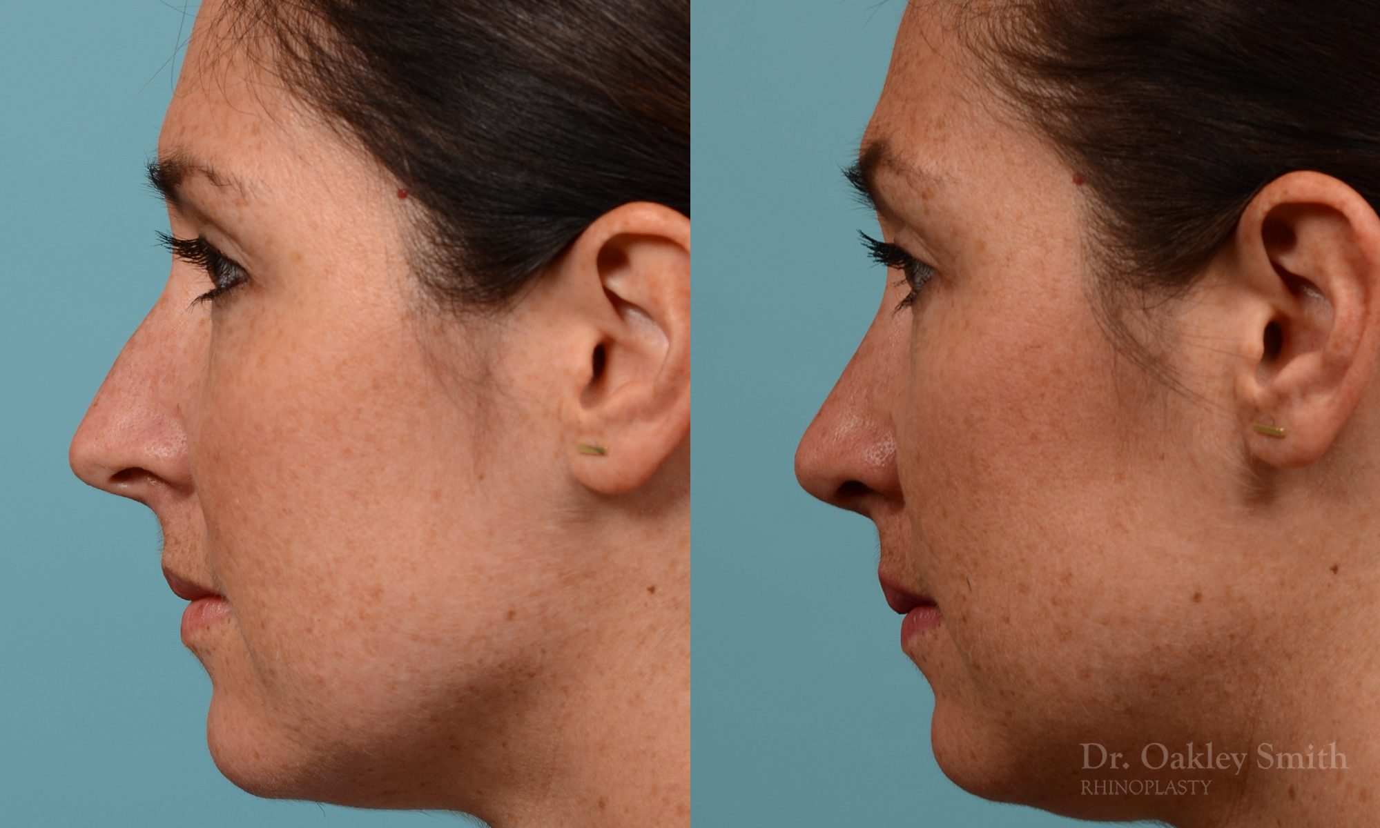 Straighten nose rhinoplasty