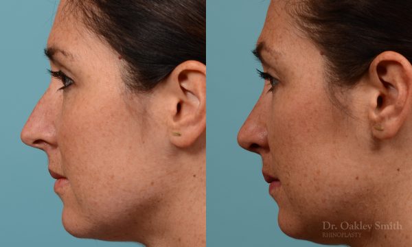 Straighten nose rhinoplasty