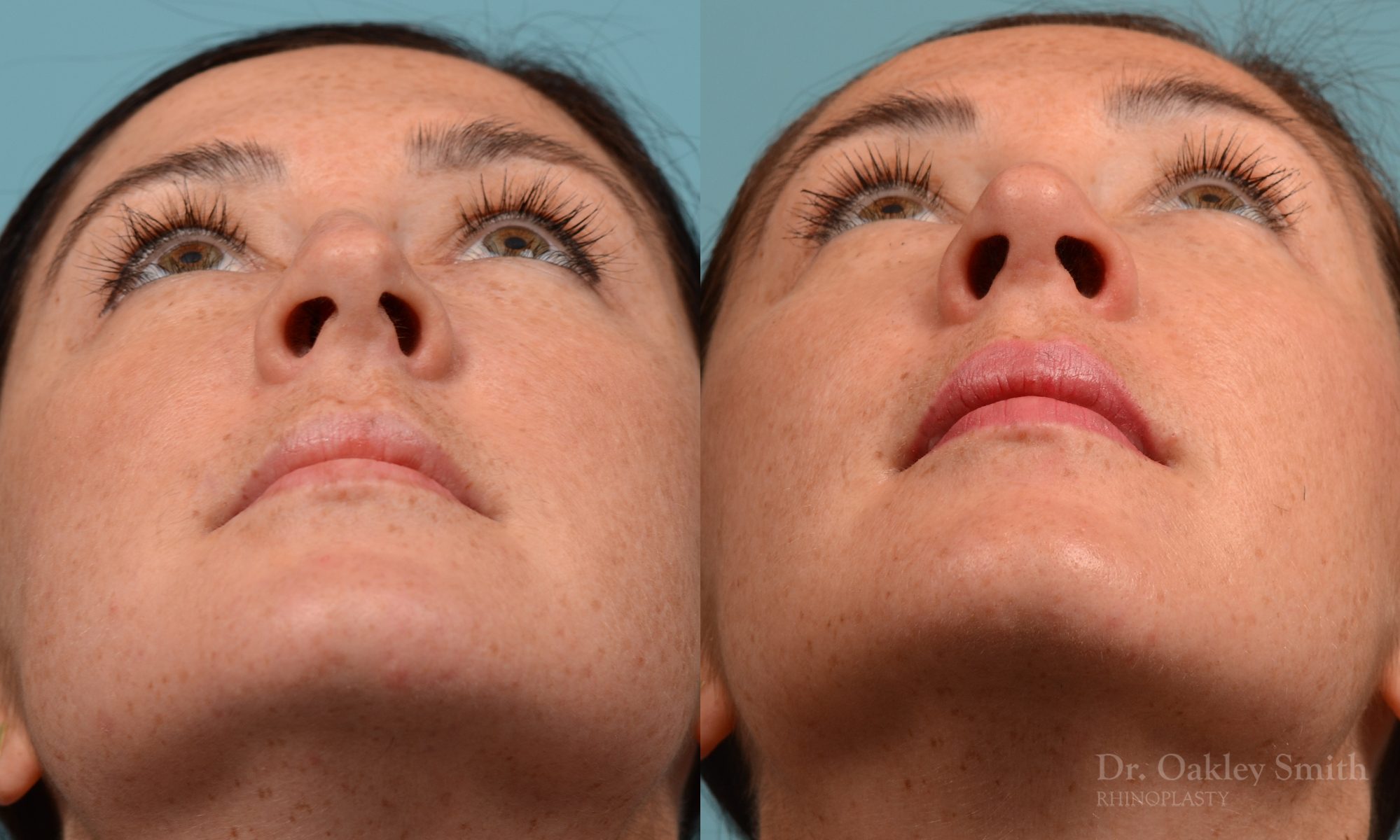 Straighten nose rhinoplasty