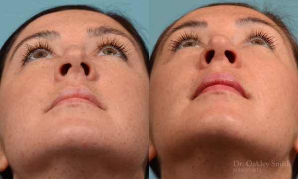 Straighten nose rhinoplasty