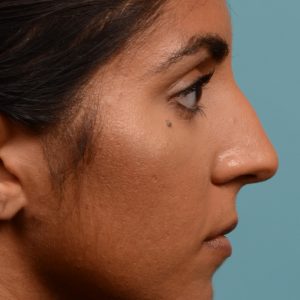 Rhinoplasty hump removal