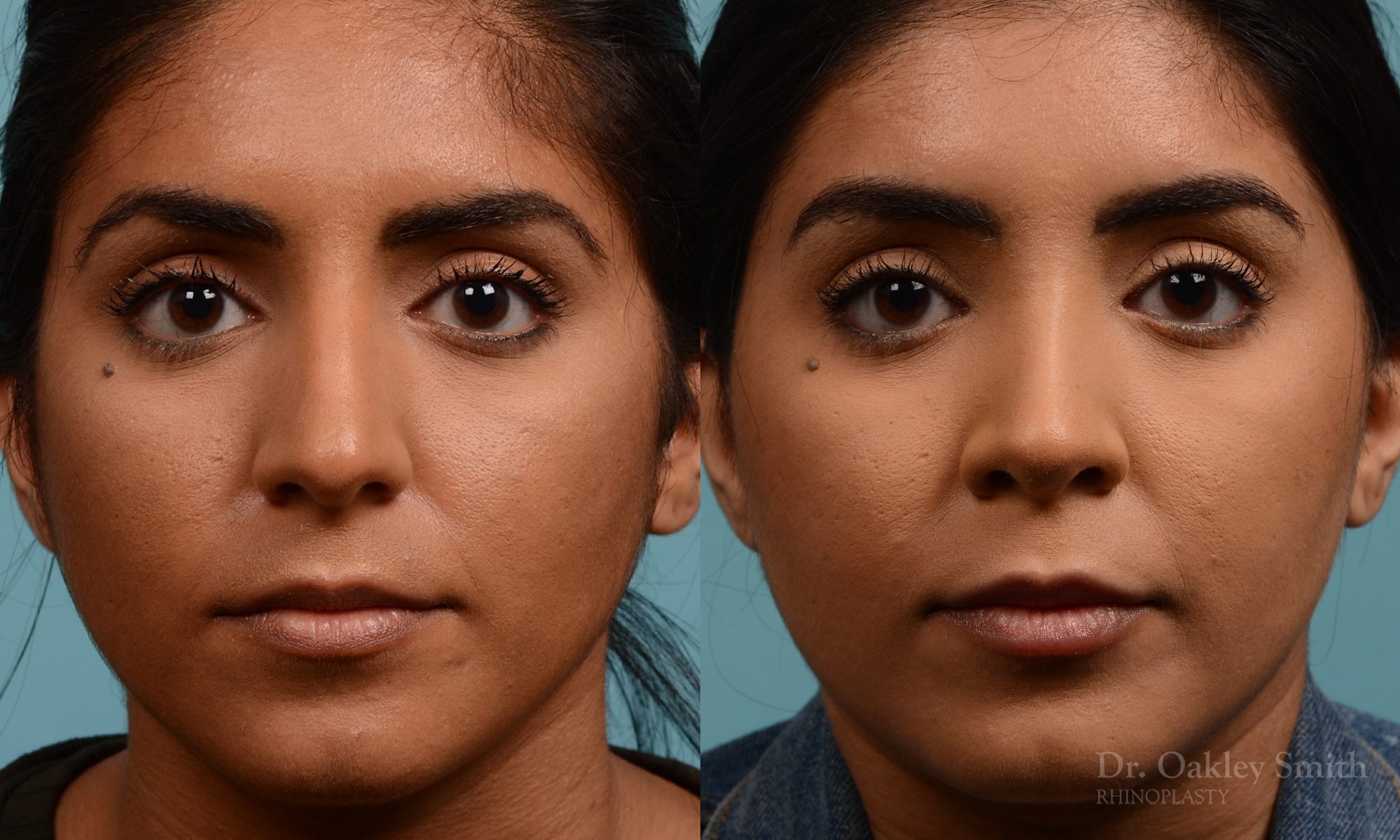 Female nose rhinoplasty remove curvature