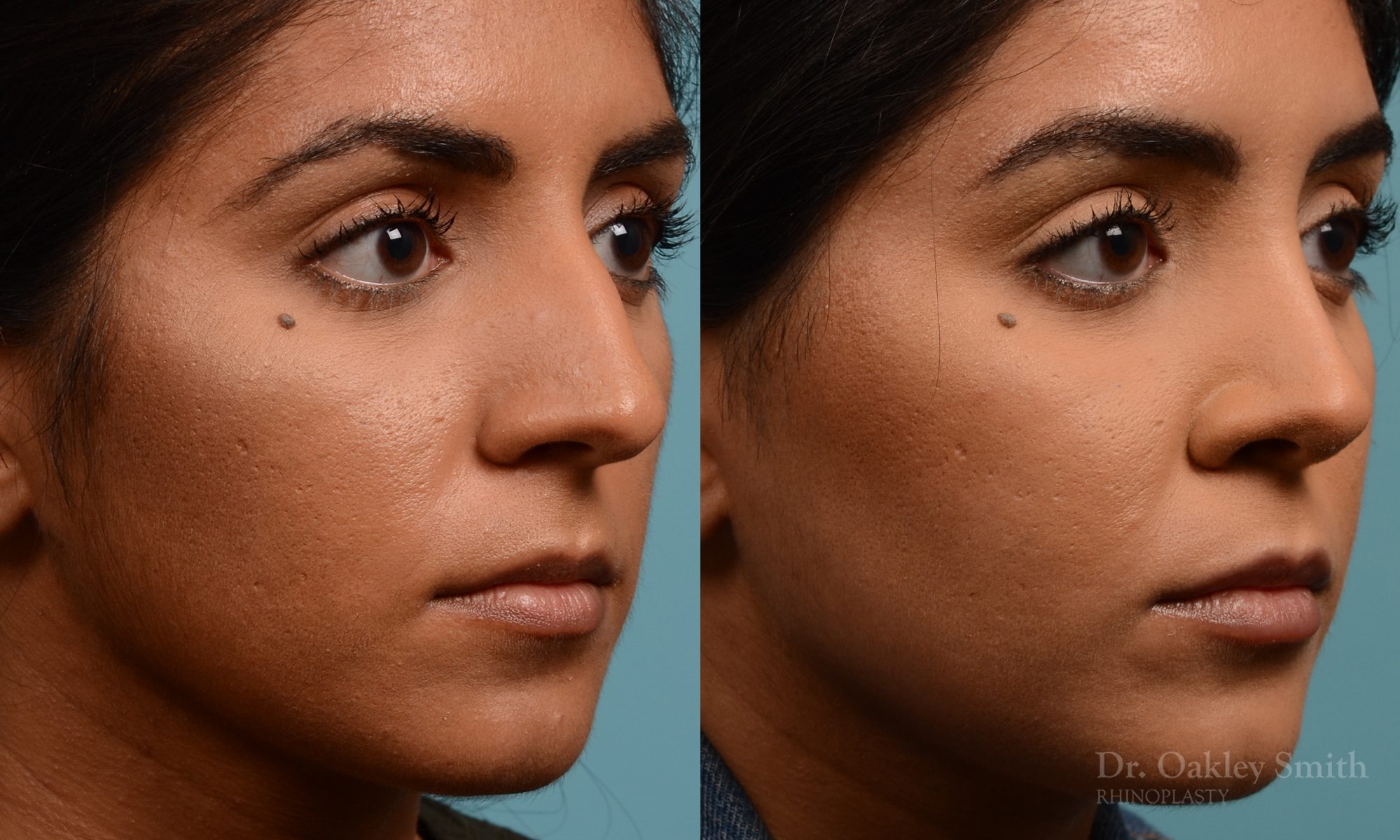 Female nose rhinoplasty remove curvature