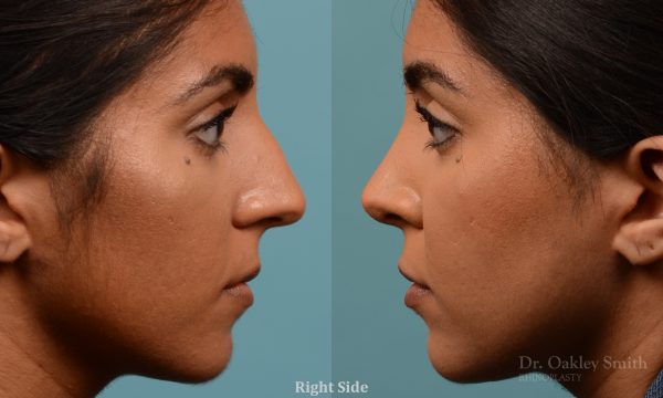 Female nose rhinoplasty remove curvature