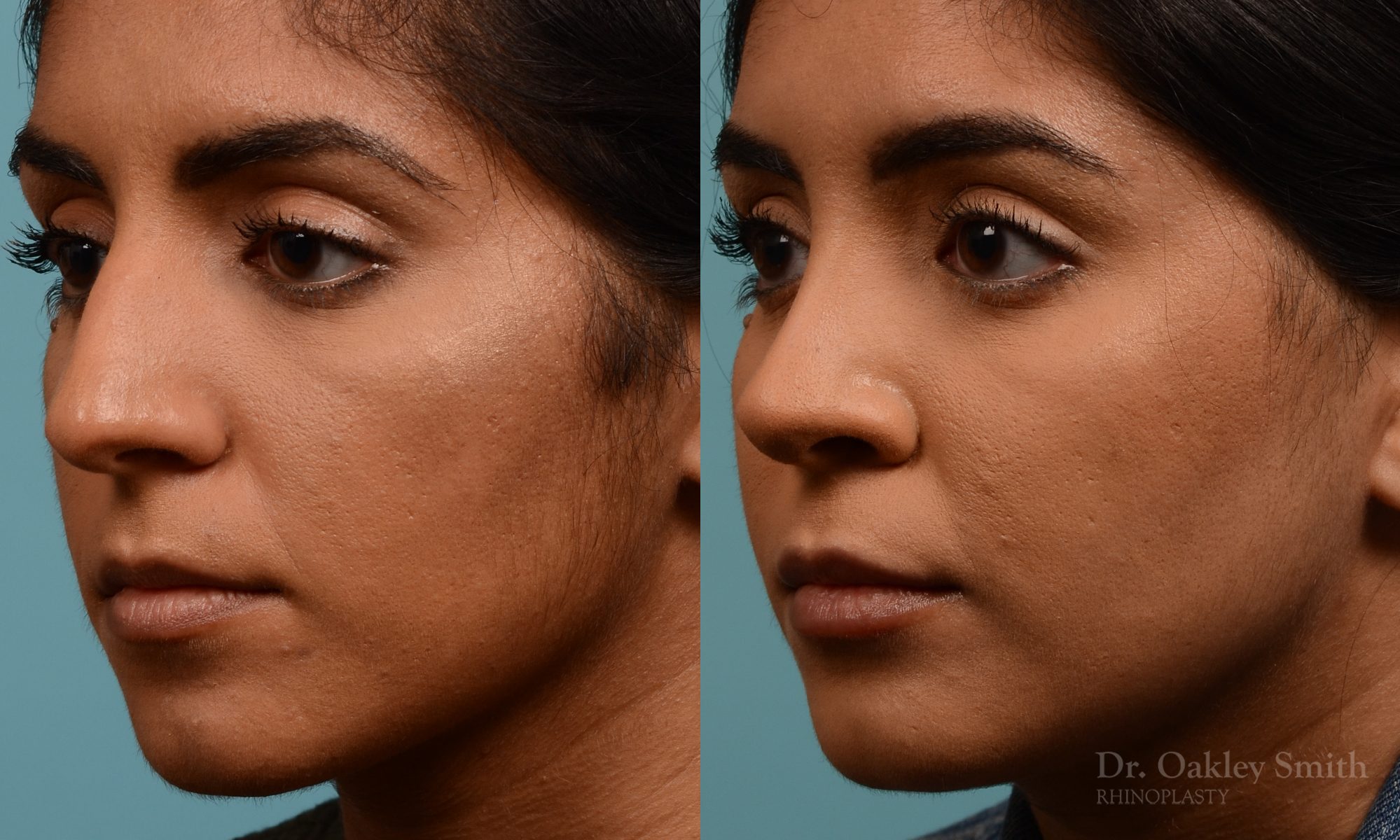 Female nose rhinoplasty remove curvature