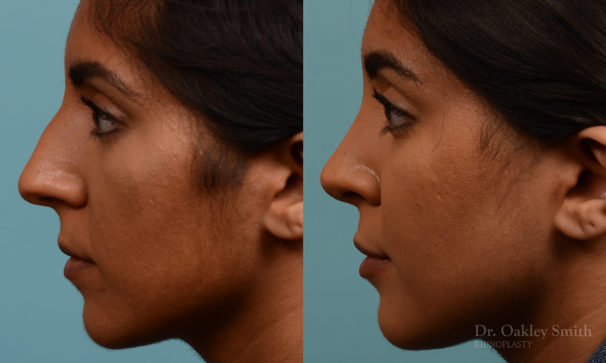 Female nose rhinoplasty remove curvature