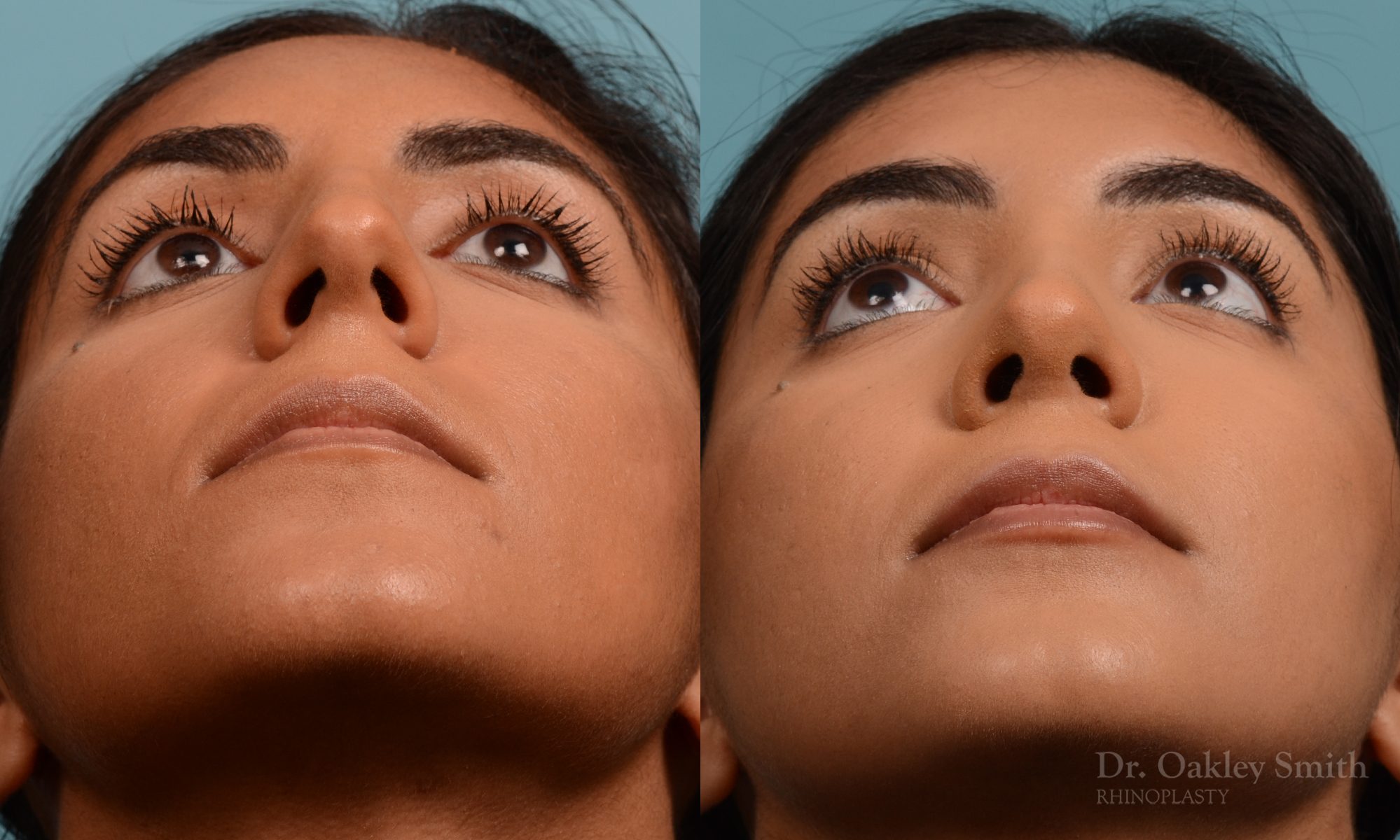 Female nose rhinoplasty remove curvature