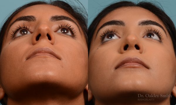 Female nose rhinoplasty remove curvature