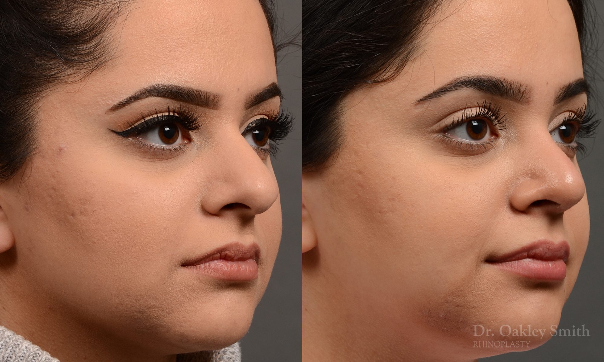 This young lady disliked the way her nose ‘hooked’.