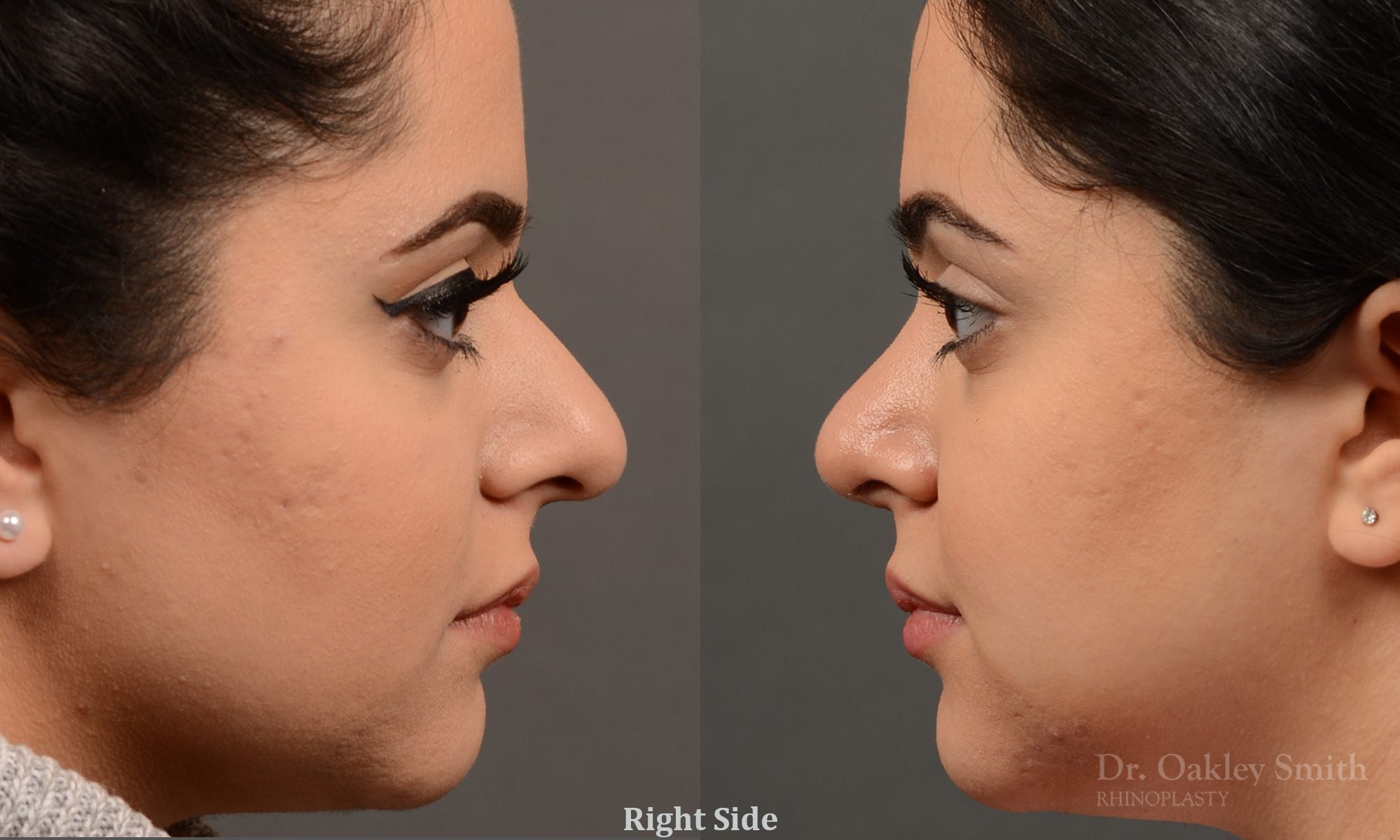 This young lady disliked the way her nose ‘hooked’.