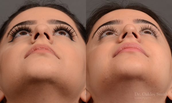 This young lady disliked the way her nose ‘hooked’.