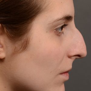 Large hump rhinoplasty nose surgery