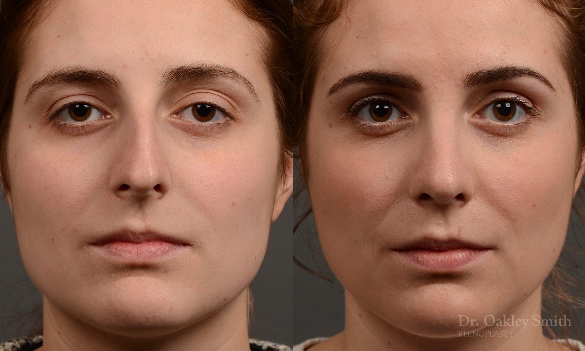 Hump reduction rhinoplasty to create a more feminine nose