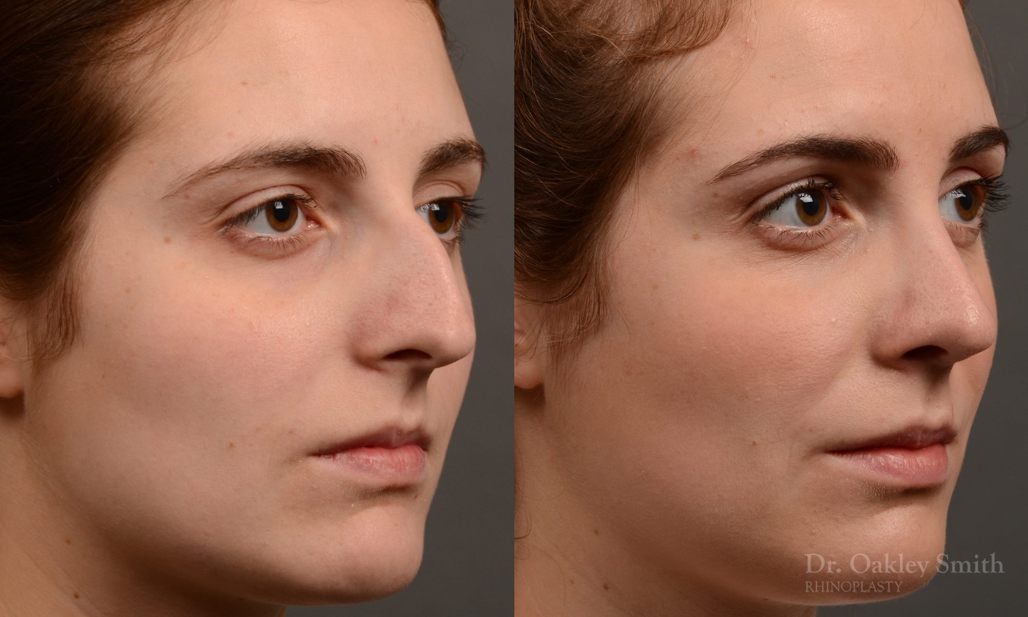 Hump reduction rhinoplasty to create a more feminine nose