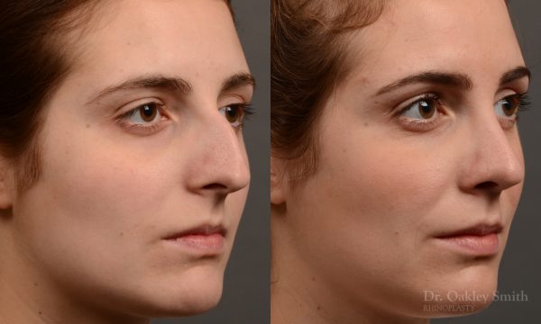 Hump reduction rhinoplasty to create a more feminine nose