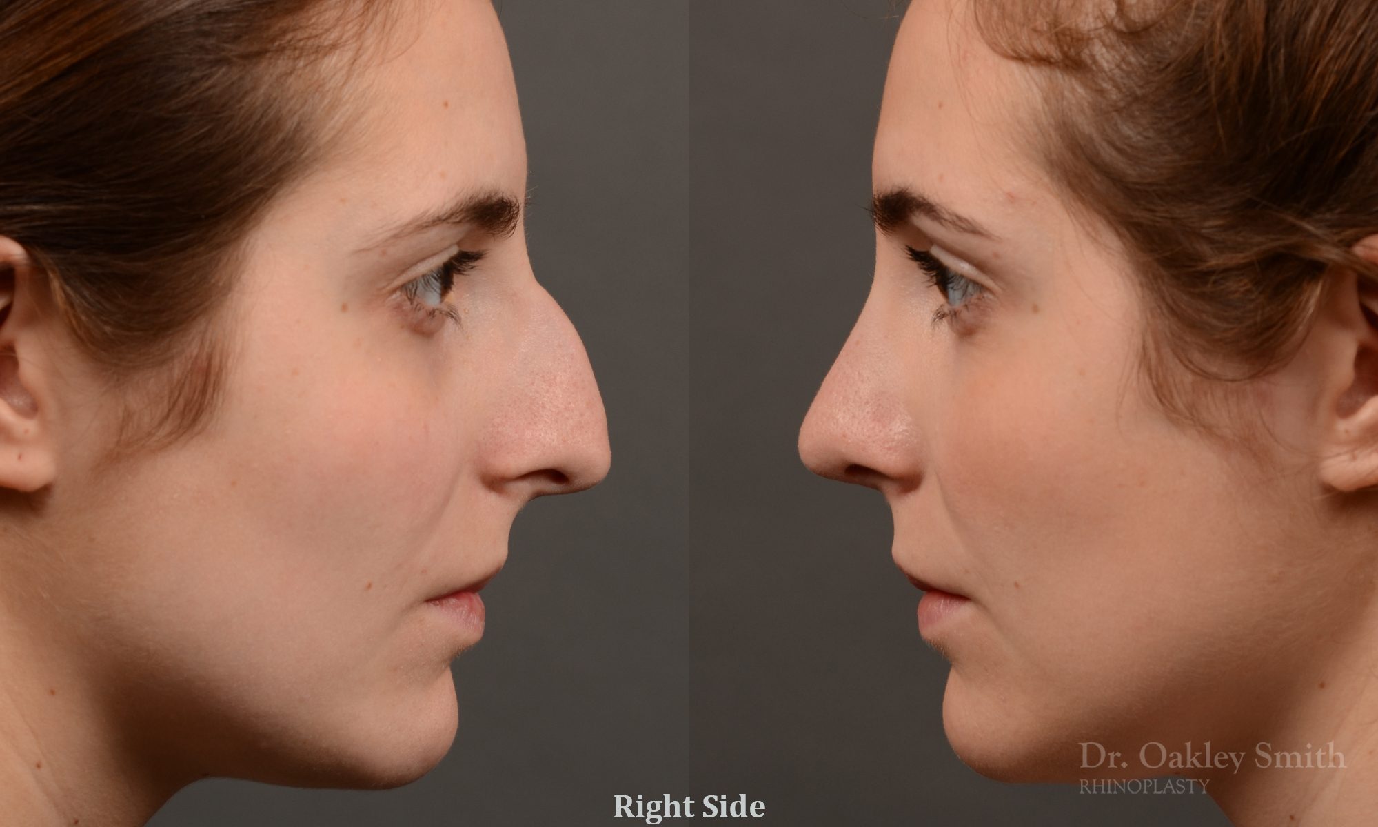 Hump reduction rhinoplasty to create a more feminine nose