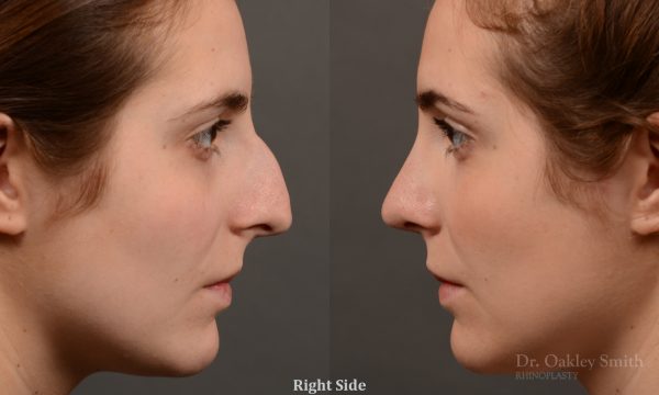 Hump reduction rhinoplasty to create a more feminine nose