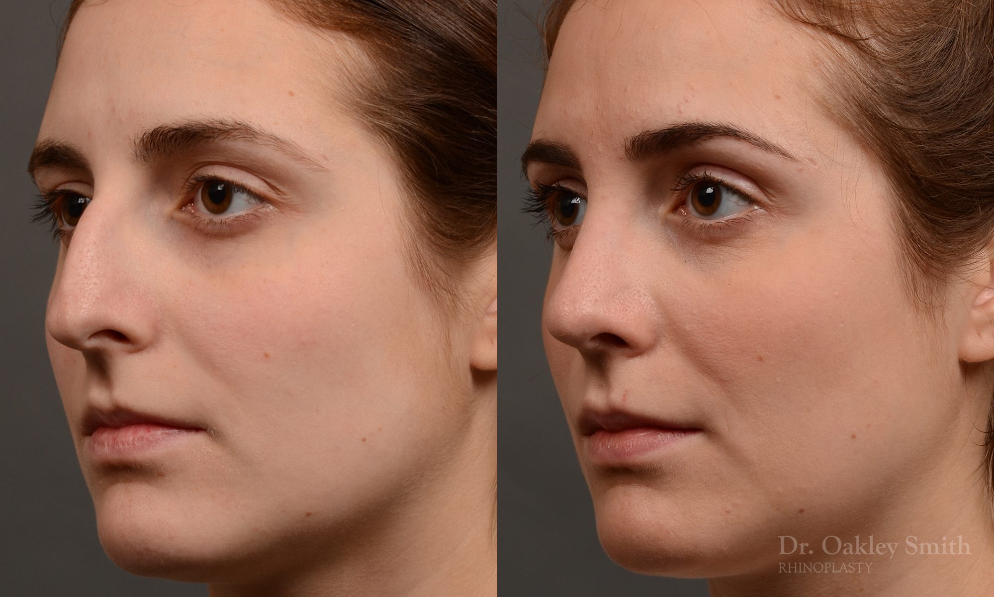 Hump reduction rhinoplasty to create a more feminine nose