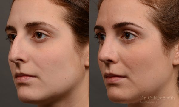 Hump reduction rhinoplasty to create a more feminine nose