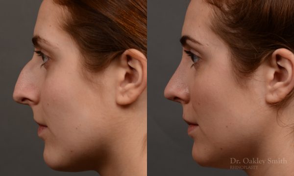 Hump reduction rhinoplasty to create a more feminine nose