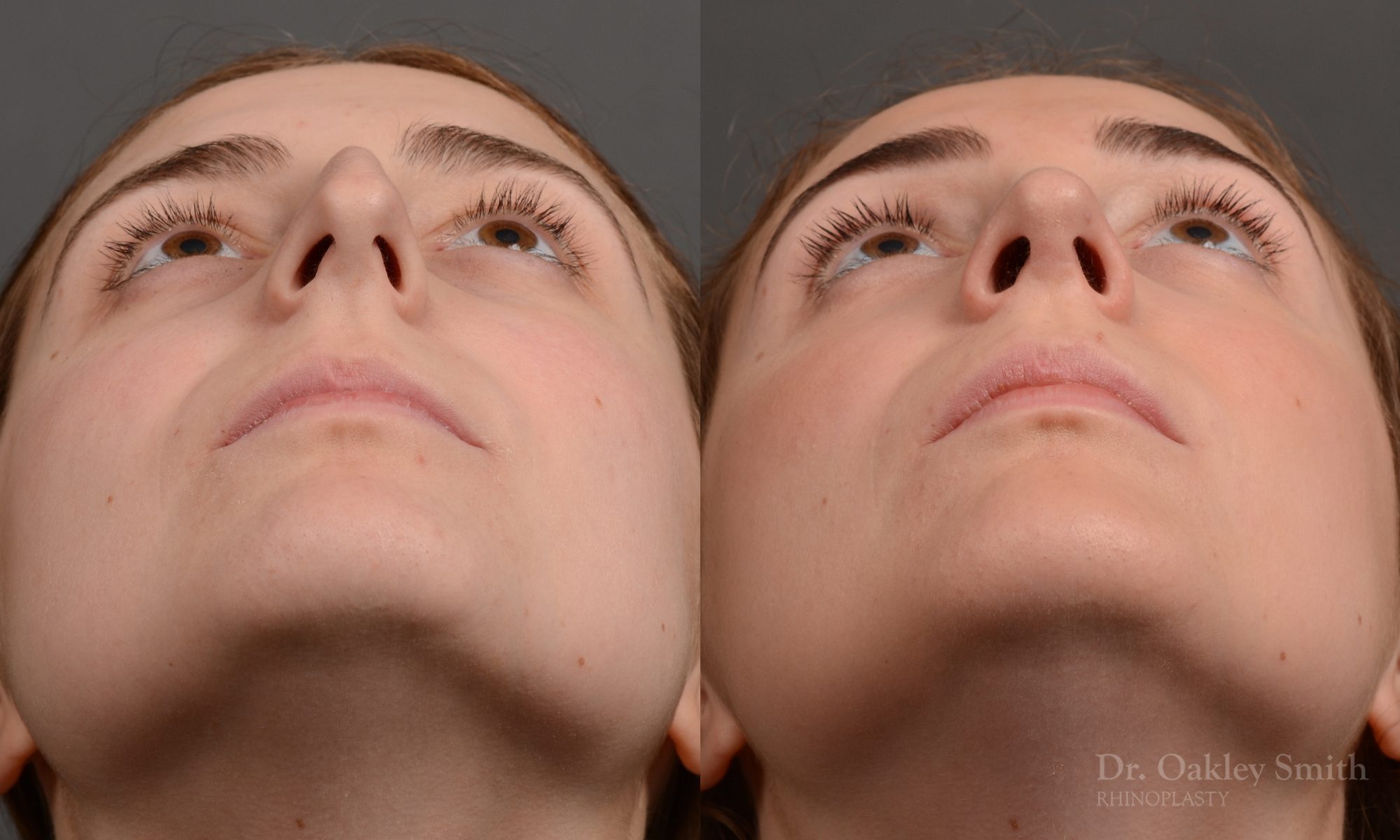 Hump reduction rhinoplasty to create a more feminine nose