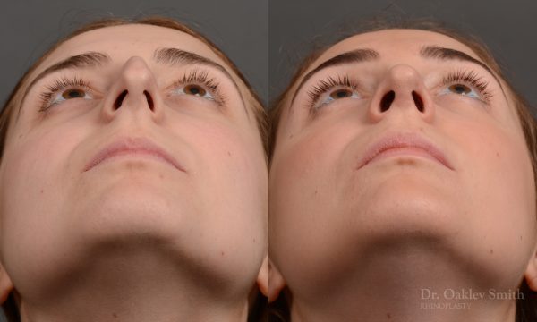 Hump reduction rhinoplasty to create a more feminine nose