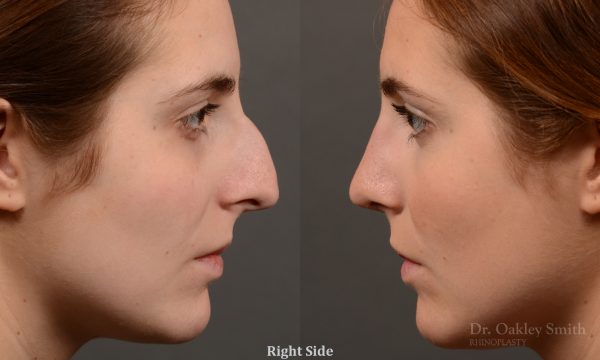 Large hump rhinoplasty nose surgery