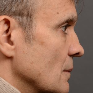 Revision Rhinoplasty - Rhinoplasty Nose Before and After Case 306