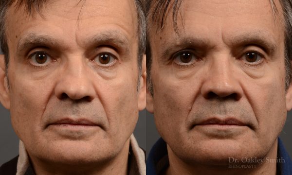 male hump reduction