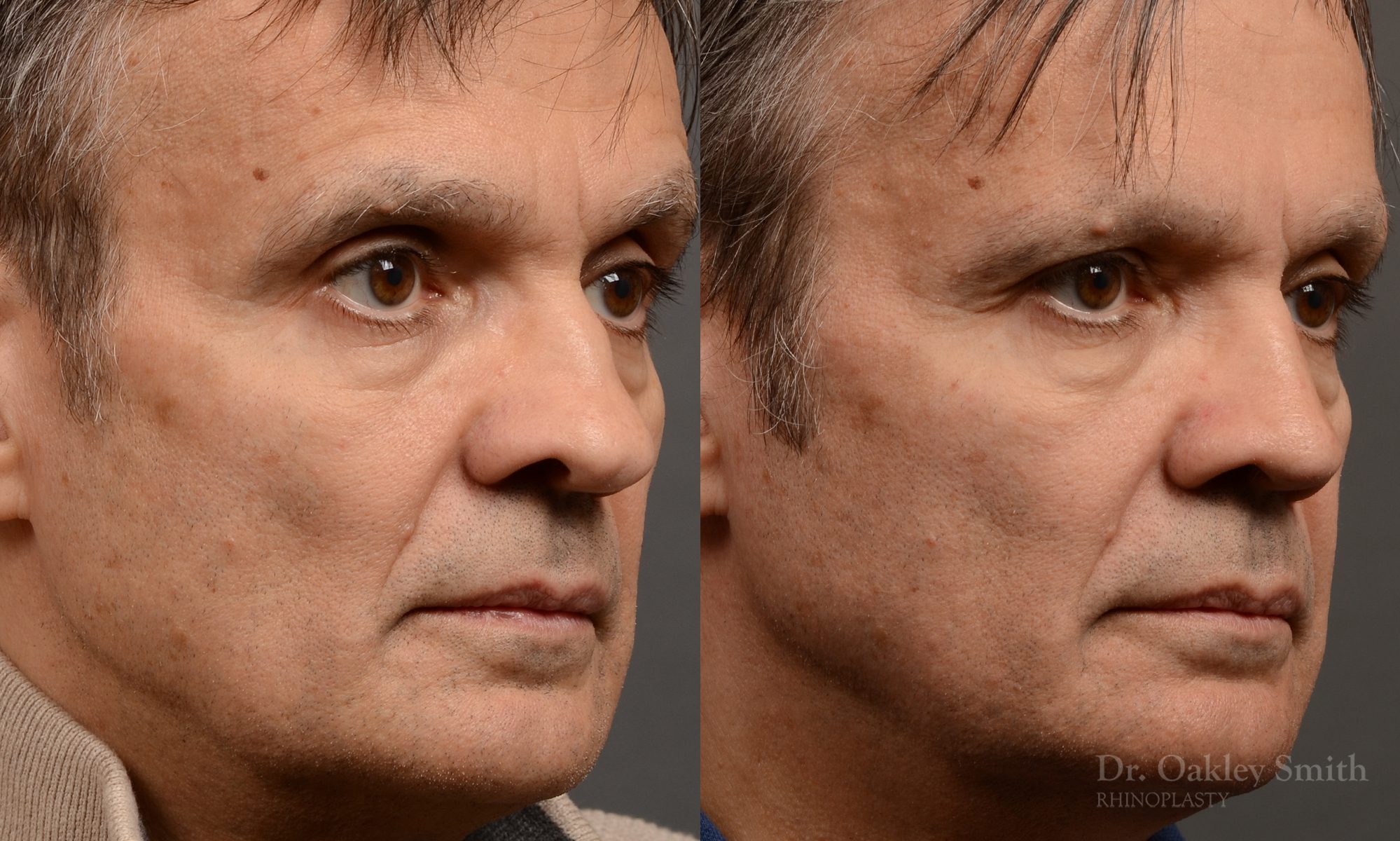 male hump reduction