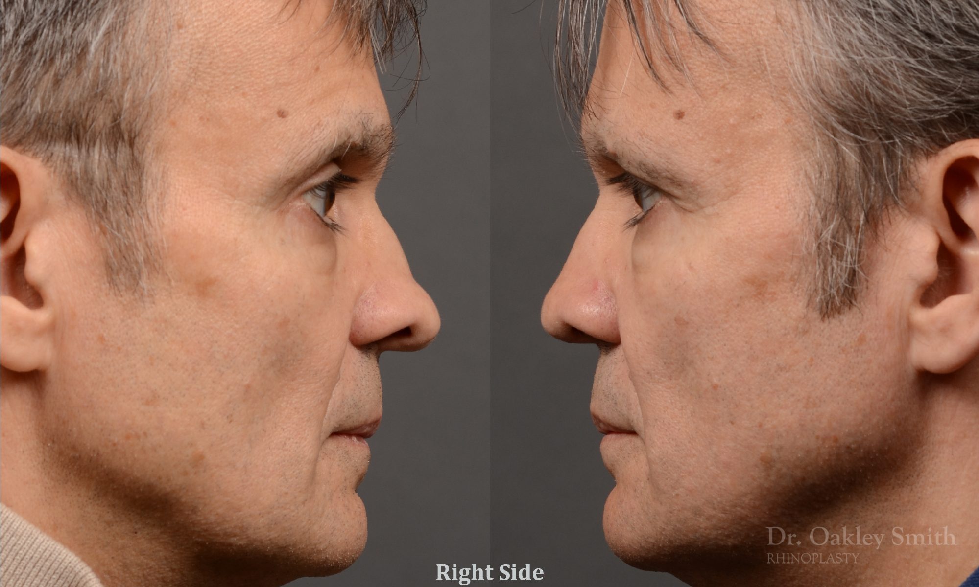 male hump reduction