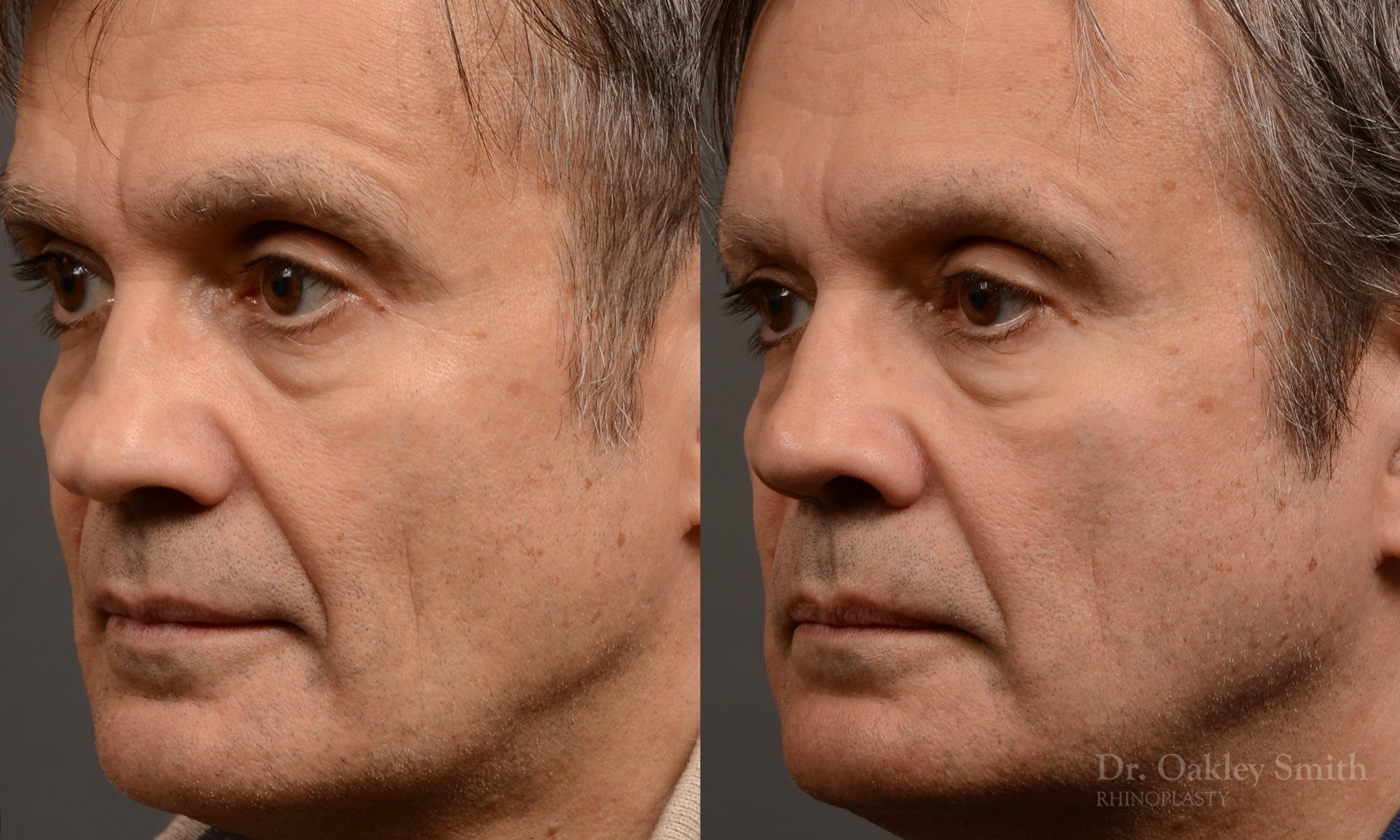 male hump reduction