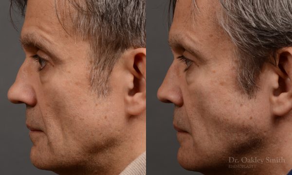 male hump reduction
