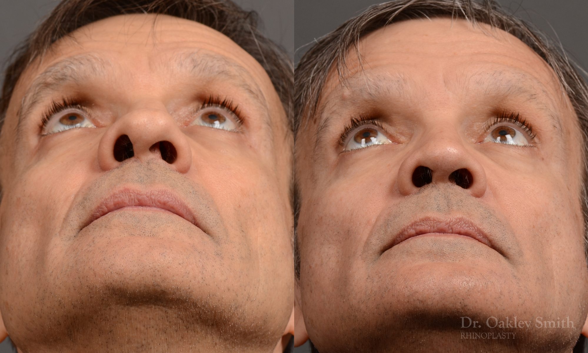 male hump reduction